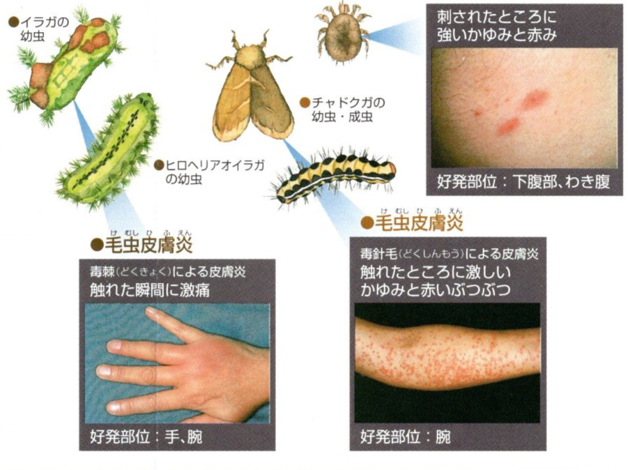 虫刺され（特に毛虫）